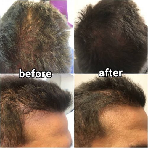 hair solution mesoinstitute caviar extract biotin mesotherapy before after Activación de los folículos pilosos activos, densidad capilar hair solution mesoinstitute caviar extract biotin mesotherapy before after
